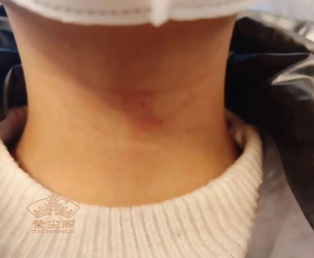 中医揪痧视频_视频中医揪痧教程_中医揪痧有什么好处