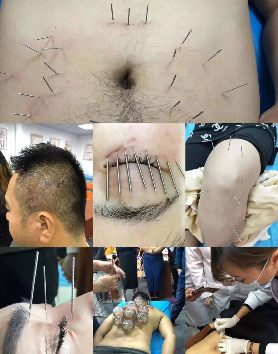 中医针炙视频讲座_针灸培训班视频_中医针灸培训视频