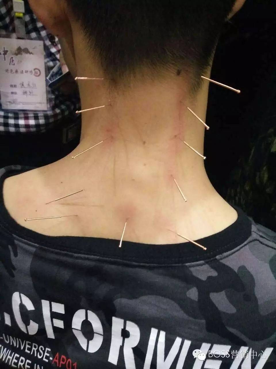 中医针灸视频教学全集_中医针灸视频教程90集_中医针灸学视频教学