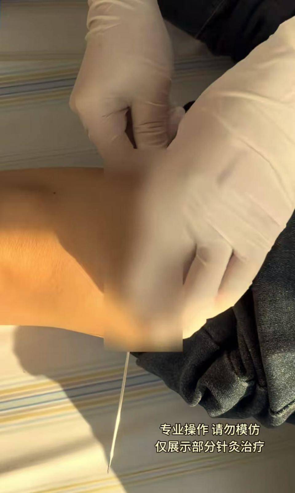 中医针灸特殊手法都有哪些_特殊中医针灸视频_中医特色针灸视频