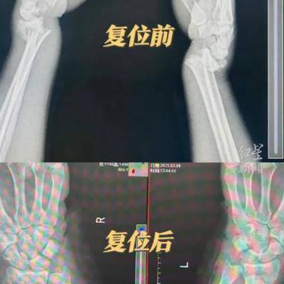 中医正骨手法视频_中医正骨的视频_中医正骨教学视频大全