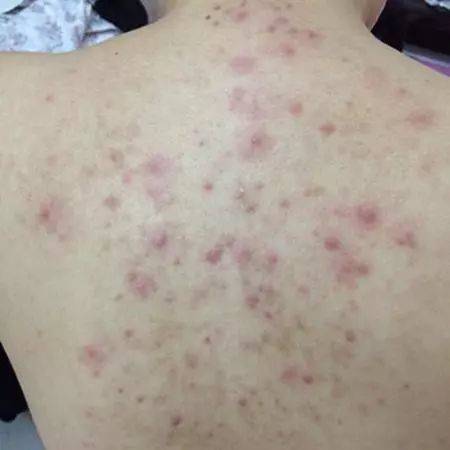 痤疮的中医_三位中医治疗痤疮的经验体会_治疗痤疮的中医书籍