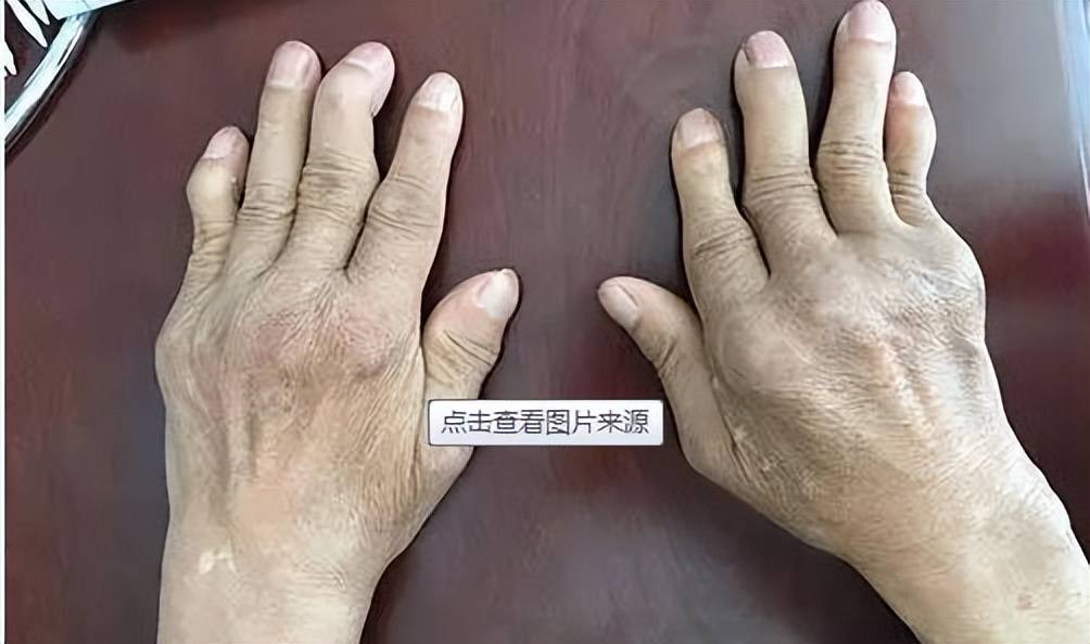 风湿关节炎中医医案_中医论风湿关节炎_风湿性关节炎医案