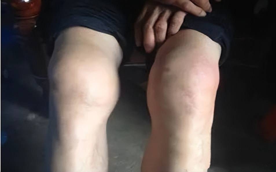 风湿性关节炎医案_风湿关节炎中医医案_中医论风湿关节炎