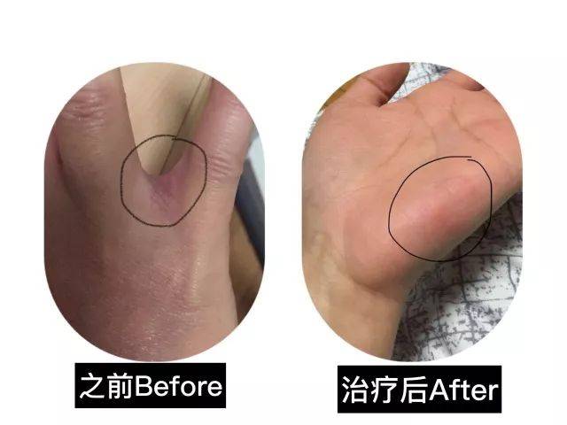 中医湿疹治疗心得_中医治疗湿疹_中医湿疹治疗方法