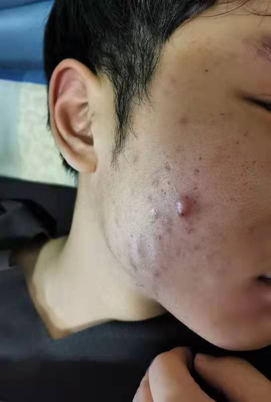 中医痤疮治疗针灸_中医治疗痤疮_中医痤疮治疗用什么药