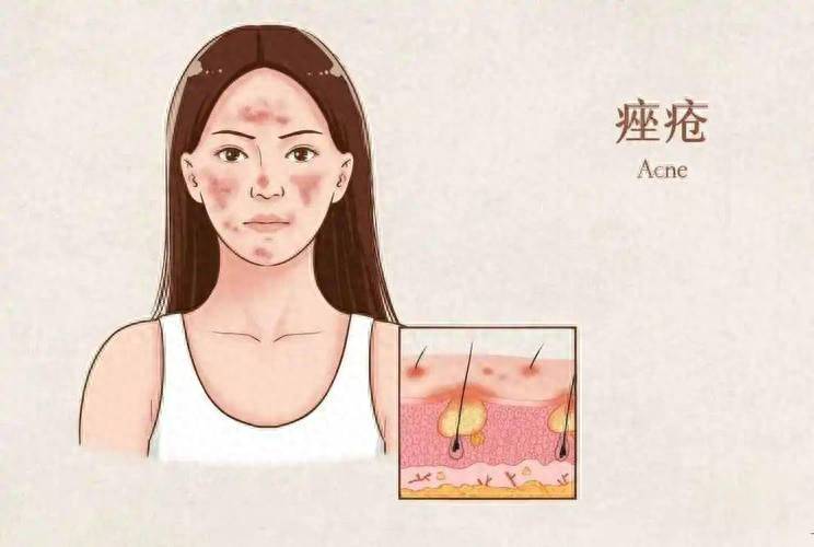 中医痤疮治疗指南_中医痤疮治疗用什么药_痤疮的中医治疗