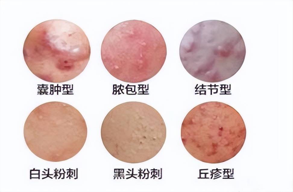 痤疮的中医治疗_中医痤疮治疗指南_中医痤疮治疗用什么药