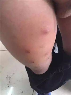 中医病治疗皮肤病的方法_中医治疗皮肤病_中医药治疗皮肤病