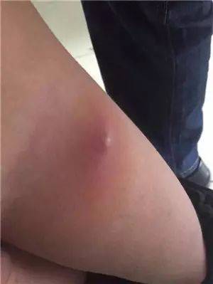 中医病治疗皮肤病的方法_中医药治疗皮肤病_中医治疗皮肤病