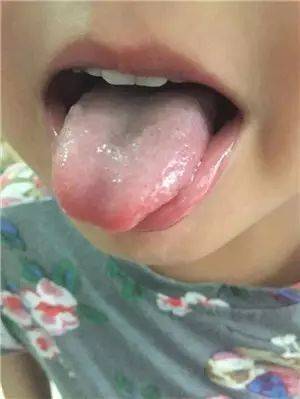 中医治疗皮肤病_中医药治疗皮肤病_中医病治疗皮肤病的方法