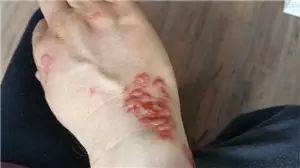 中医药治疗皮肤病_中医病治疗皮肤病的方法_中医治疗皮肤病