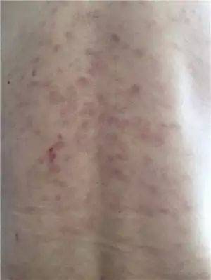 中医药治疗皮肤病_中医治疗皮肤病_中医病治疗皮肤病的方法