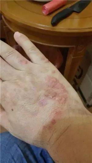中医药治疗皮肤病_中医治疗皮肤病_中医病治疗皮肤病的方法