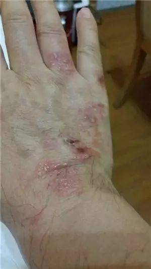 中医药治疗皮肤病_中医治疗皮肤病_中医病治疗皮肤病的方法