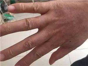 中医治疗皮肤病_中医药治疗皮肤病_中医病治疗皮肤病的方法