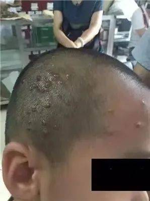 中医病治疗皮肤病的方法_中医治疗皮肤病_中医药治疗皮肤病