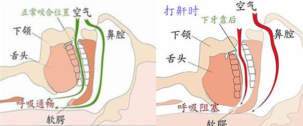 中医治疗打呼噜_中医治疗打呼噜的方子_中医有治疗打呼噜的药方吗