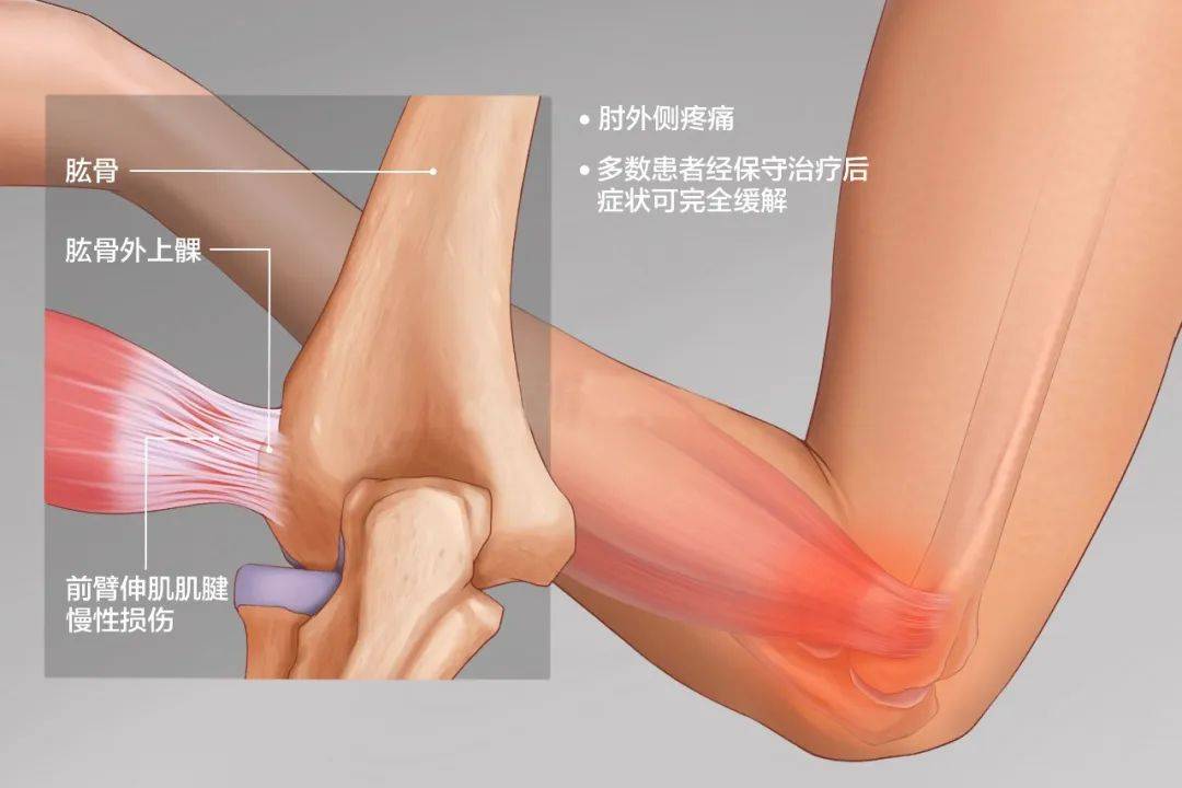中医治疗网球肘_网球肘的中医疗法_网球肘中医叫什么名