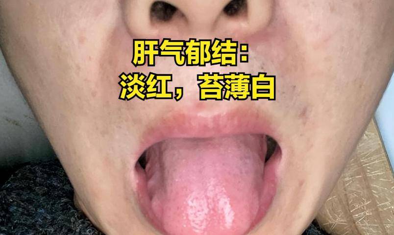 中医的肝气郁结_中医症状郁结肝气不足_中医肝气郁结的症状