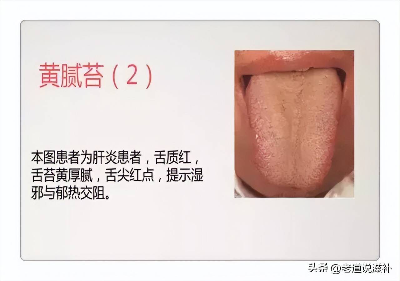 中医舌诊图片及症状_中医症状分类_中医症状对照表