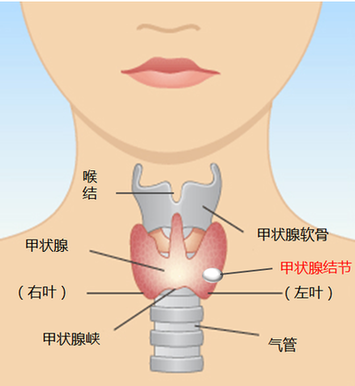 甲状腺结节中医疗法_中医论治甲状腺结节_中医对甲状腺结节的治疗效果