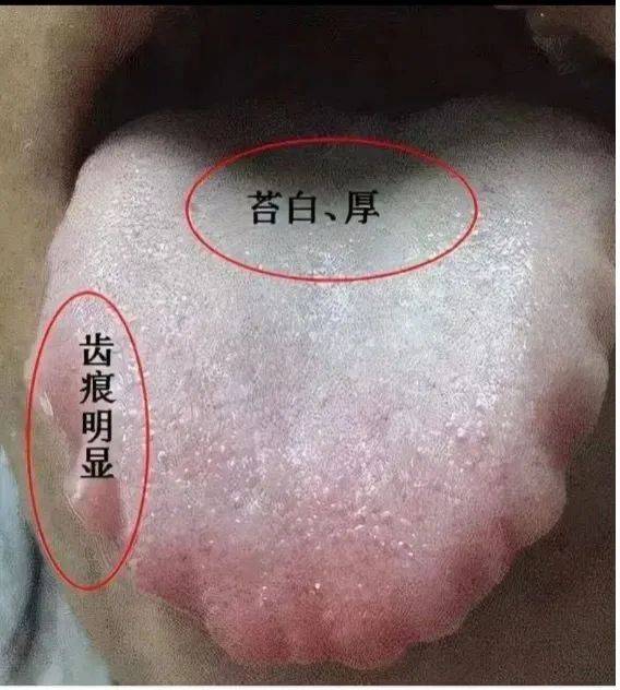 中医祛除湿气会复发吗_中医祛除湿气的最佳特效药方_中医怎么祛除湿气