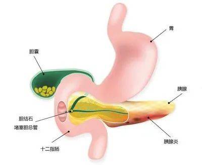胆囊炎秘方中医报_中医治疗胆囊炎有秘方_中医治胆囊炎经典方