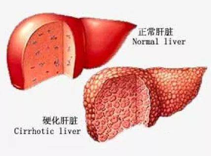 出血肝硬化中医秘方治疗视频_治疗肝硬化出血的偏方_中医治疗肝硬化出血的秘方